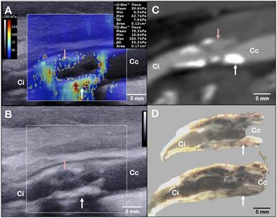 Innovative Multiparametric Characterization of Carotid Plaque Vulnerability by Ultrasound